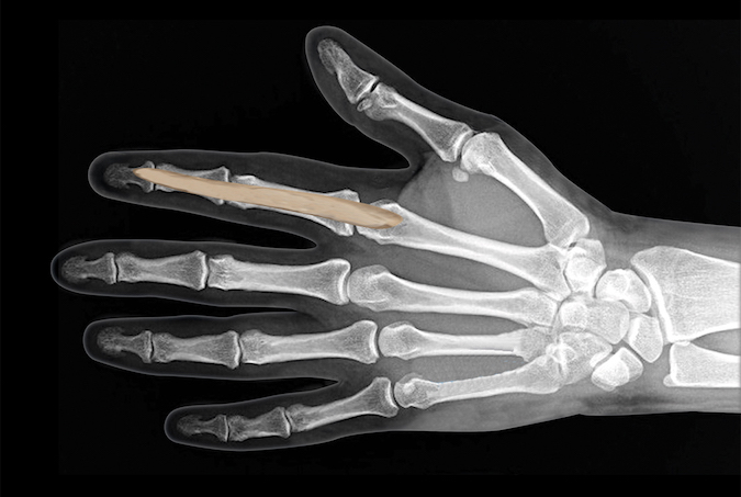 Index flexor tendon sheath which can rupture into the thenar space.