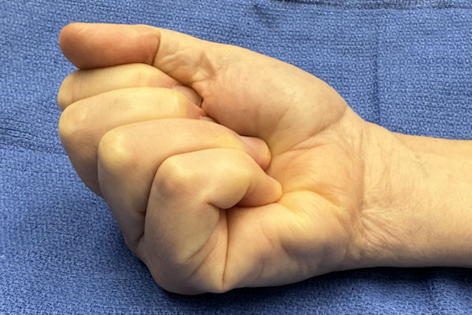 Active normal fisting suggesting intact flexor tendons.