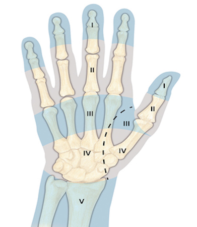 Flexor Tendon Zones of injury for fingers, thumb, hand, and wrist. The most difficult repairs are those done in Zone II where the fibro osseous tunnel of the flexor tendon sheath is narrow and tight. Note difference between ASAR sections and flexor/extensor tendon injury zones.