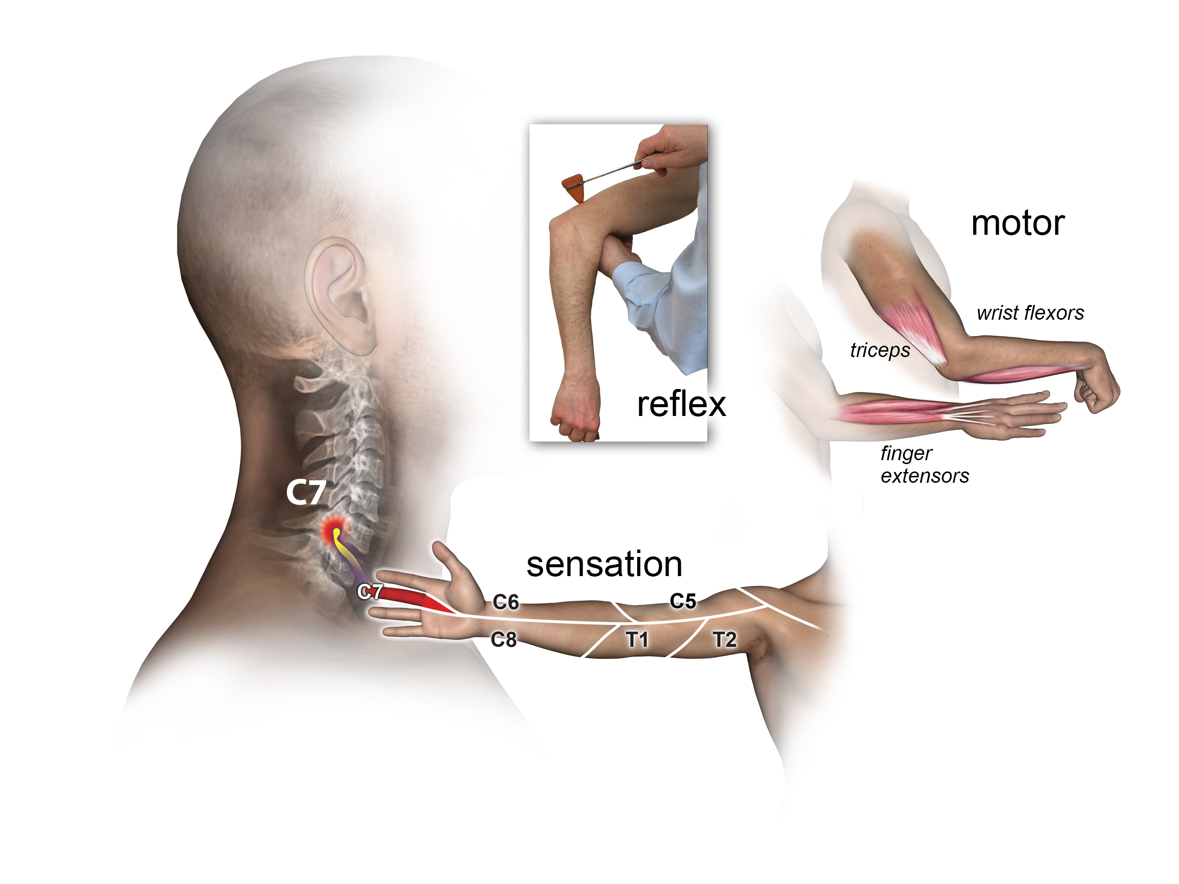 Motor, sensory and reflex exam for C7 Root.