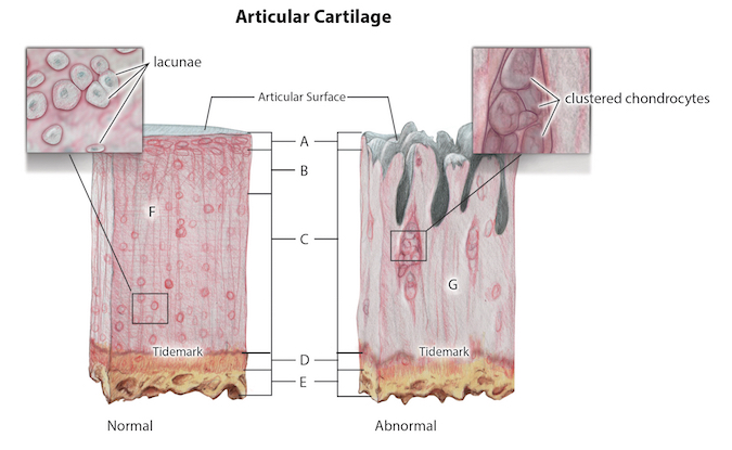 Normal and arthritic cartilage.