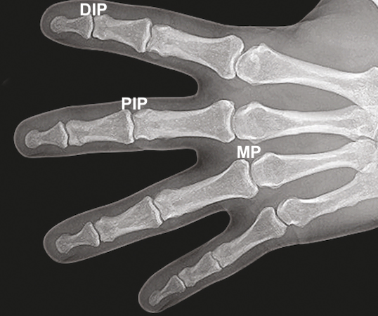 Hand X-ray showing the DIP, PIP, and MP joints.