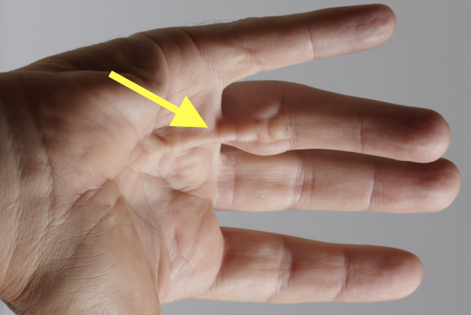 Long finger showing an MP joint flexion contracture secondary to a classic Dupuytren's disease central cord (yellow arrow). 