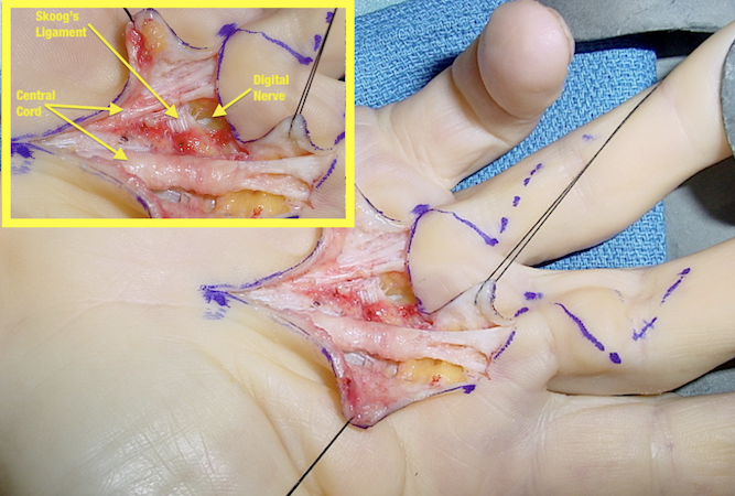 Dupuytren's disease central cords to the long and ring fingers.  Insert shows the central cords, Skoog's ligaments, and the common digital nerve.