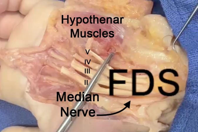 The FDS tendons have been cut at the section 8/7 junction and pulled out of the carpal tunnel.