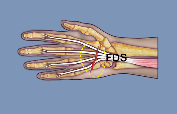 Flexor Digitorum Superficialis (FDS) II - V  are at risk for transection in section 8 (yellow oval).