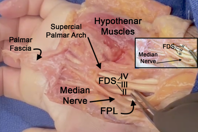 The carpal tunnel is opened. Note the FPL tendon, median nerve, FDS tendons II,III,&IV, and the superficial arch. Insert shows FDS tendons III,IV,& V. FDS II is radial and dorsal to FDS III while FDS V is ulnar and dorsal to FDS IV.