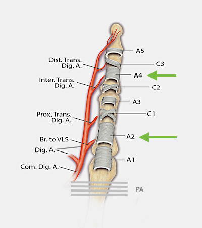 This diagram highlights the vascular supply and components of the flexor tendon sheath. The three cruciate pulleys (C1-3), the five annular pulleys (A1-A5) and the palmar aponeurotic pulley (PA) are shown. The A2 and A4 pulleys (green arrows) are the biomechanically the most important pulleys. During flexor tendon surgery, Tang has shown that the A2 pulley can be 50% excised or vented and the A4 can be 100% vented if needed for tendon excursion if the other parts of the sheath are intact.