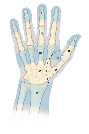 Flexor Tendon  Injury Zones of injury for the hand and wrist. The most difficult repairs are those done in Zone II where the fibro osseous tunnel of the flexor tendon sheath is narrow and tight. Note difference between ASAR sections and flexor/extensor tendon injury zones.