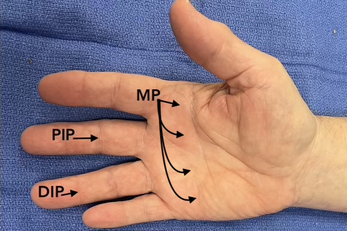 Note the MP joints are at or near the distal palmar crease.