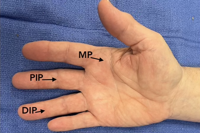 Note the location of the DIP, PIP, and MP joints on the palm of an injured hand.