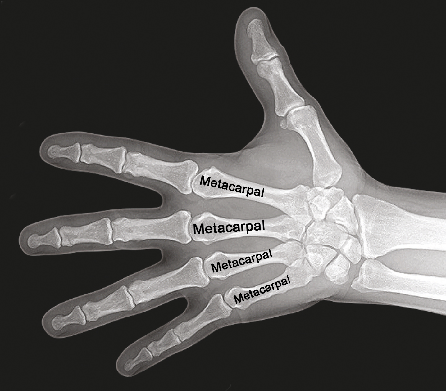 Hand X-ray showing the index, long, ring, and little metacarpals.