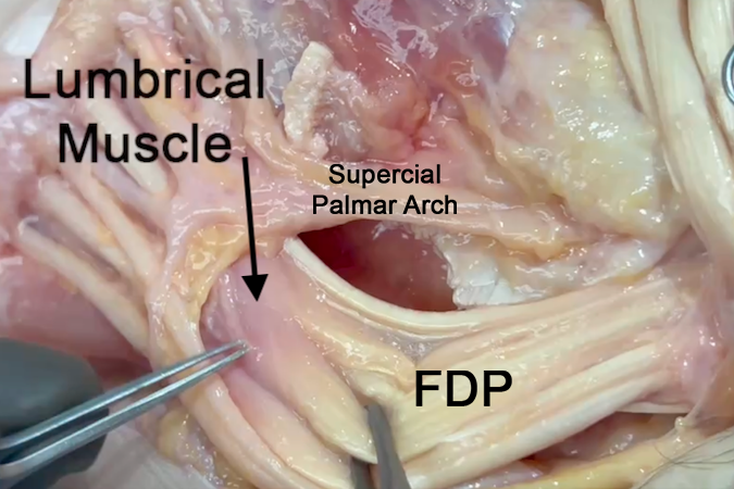 Note the lumbrical muscles at their origin on the FDP tendons.  The FDS tendons have been cut distally and pulled out of the carpal tunnel.