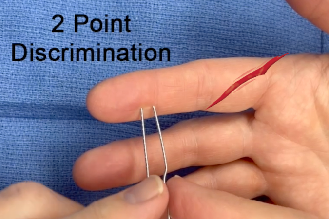 Testing two point discrimination distal to a laceration.