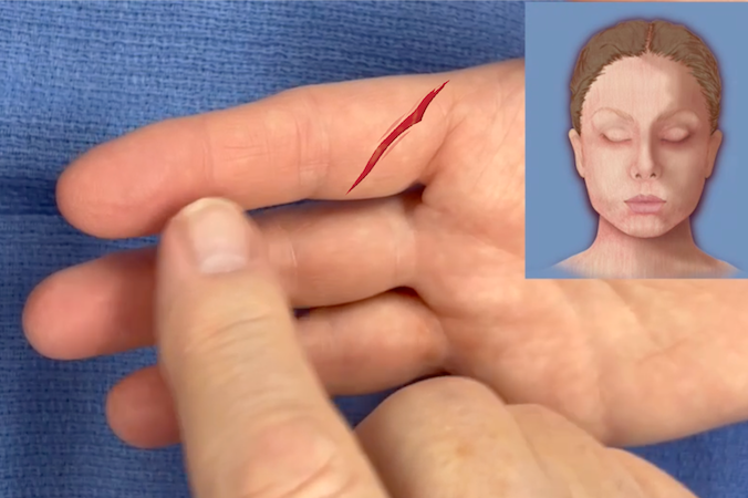 Testing light touch distal to a laceration.  Note patient's eyes are closed.