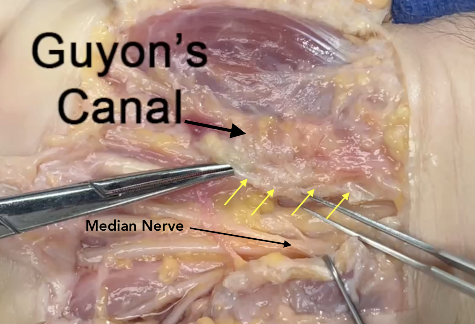 Guyon's Canal located ulnar to the carpal tunnel.  Note ulnar cut edge of the transverse carpal ligament and median nerve in carpal open carpal tunnel.