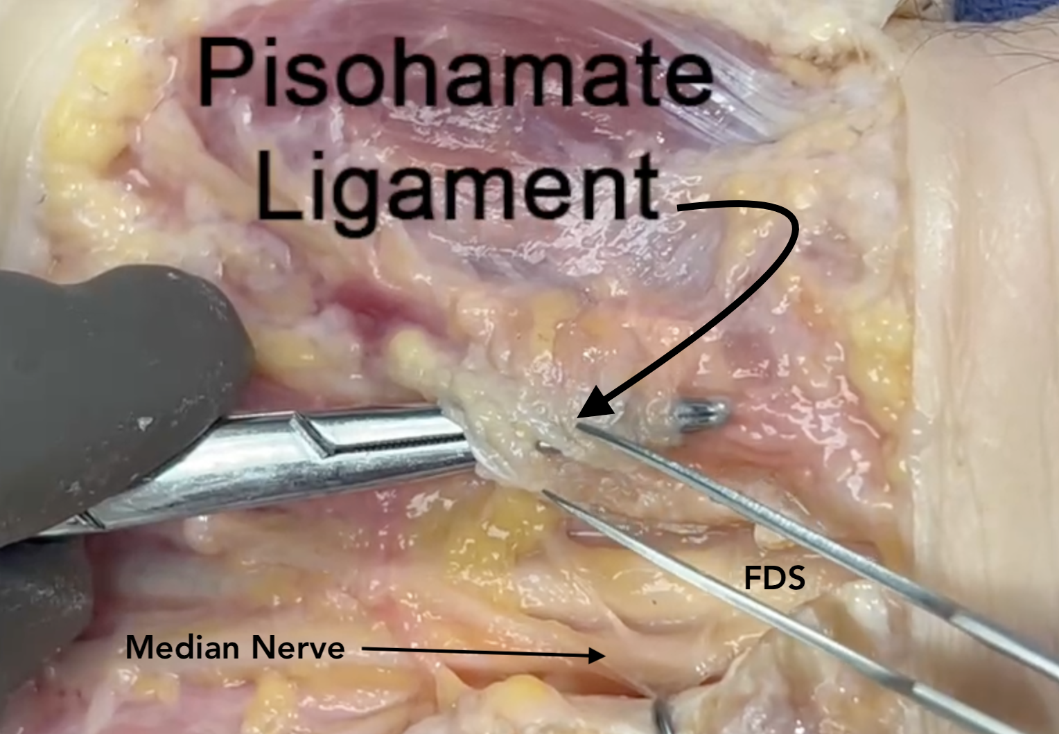 Opening pisohamate ligament of Guyon's canal.