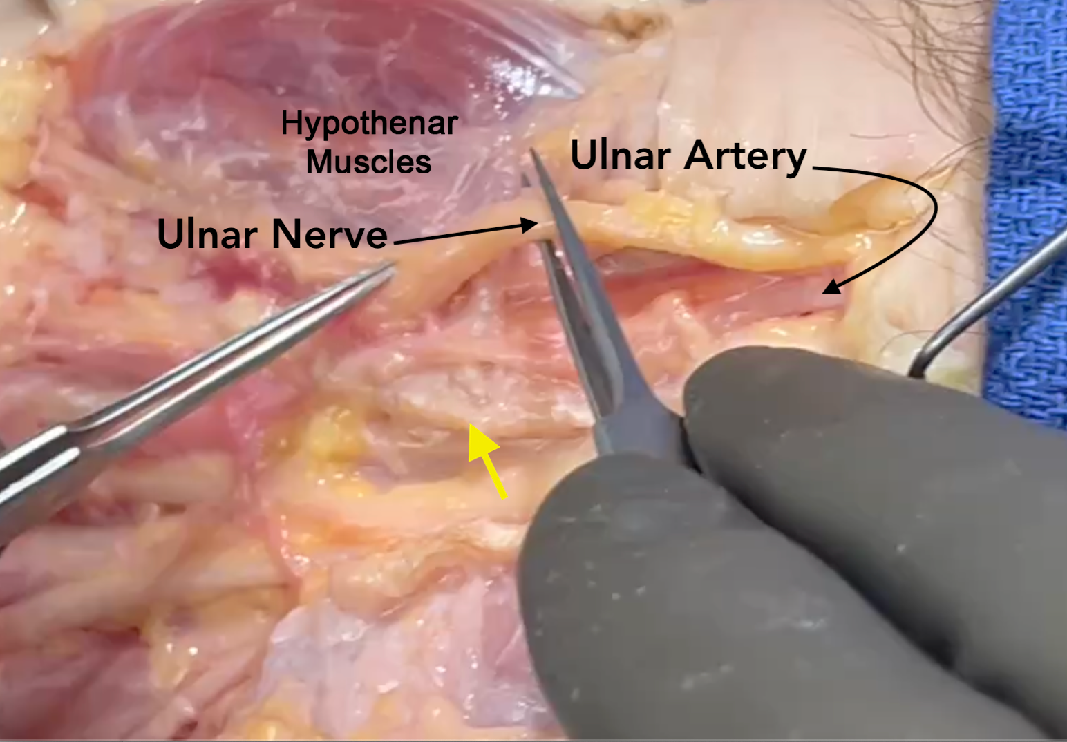 Ulnar nerve and artery in Guyon's canal. Yellow arrow on cut edge of pisohamate ligament and ulnar edge of the transverse carpal ligament.