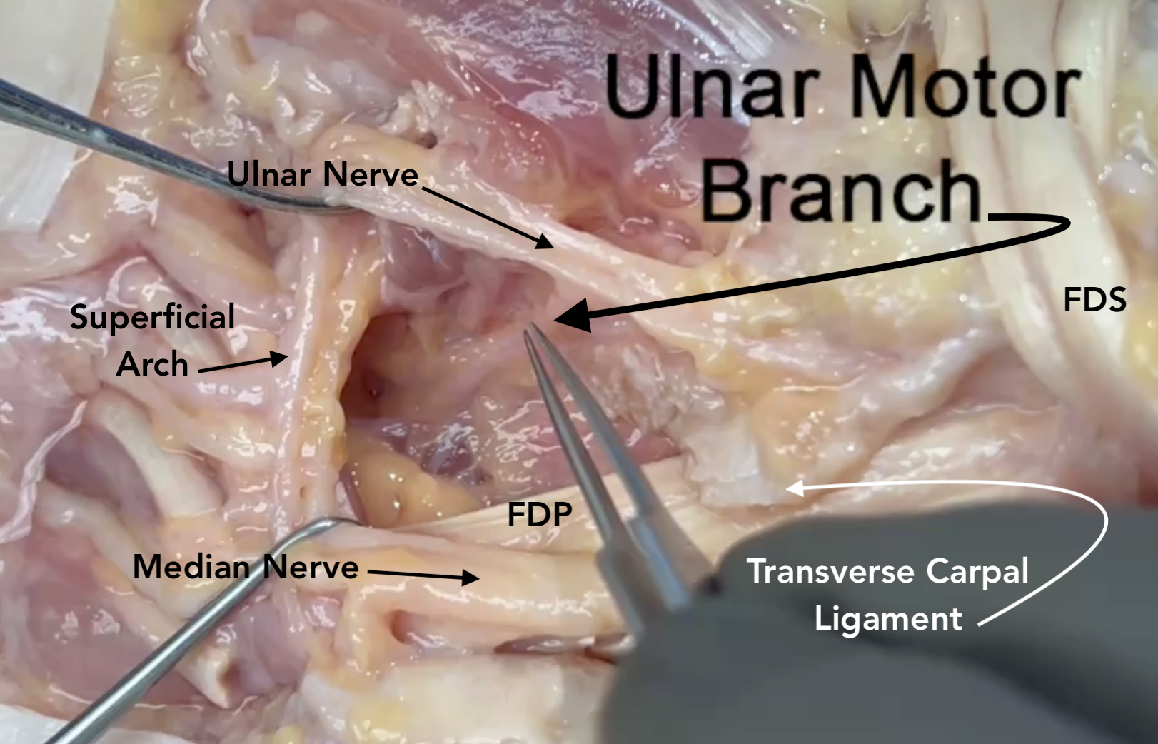 Motor branch of ulnar nerve