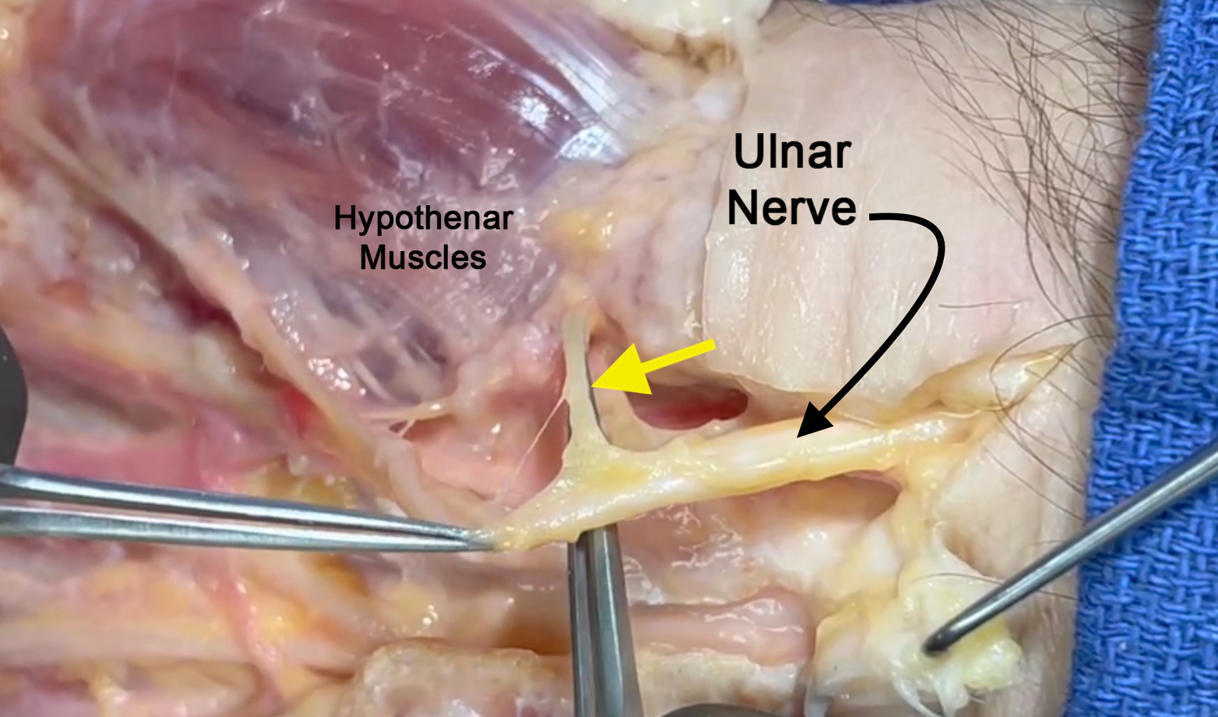 Motor branch of ulnar nerve to hypothenar muscles (yellow arrow).