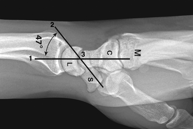 X-rays can be very helpful when assessing carpal area injuries. On a normal neutral rotation lateral, the horizontal axis of the radius, lunate, capitate, and metacarpals is a straight line (1). A line (2) the longitudinal axis of the scaphoid crosses line (1) at point (3). The average normal angle between these lines is 47° (range 30-60°). Angles outside this range suggest carpal instability (DISI >60°; VISI <30°).