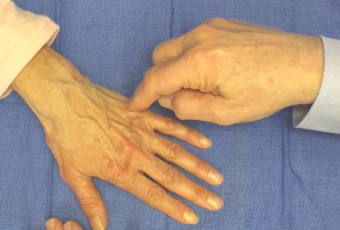 Assessing dorsal ulnar nerve sensation of ulnar dorsal hand and little finger by examining light touch.