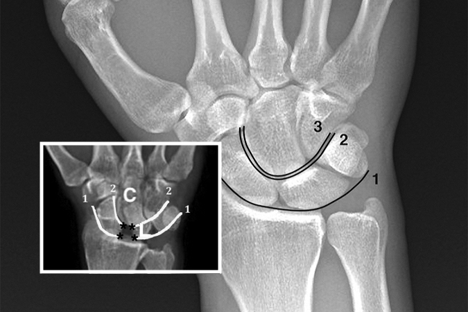 Injuries disrupt Gilula's lines. Normal Gilula's lines superimposed on a neutral deviation PA wrist x-ray. Arc 1 is a smooth arcing line paralleling the proximal articular surfaces of the triquetrum, lunate, and scaphoid. Arc 2 parallels the distal concave surfaces of the triquetrum, lunate, and scaphoid. Arc 3 parallels the smooth curved surface of the proximal hamate and capitate. 