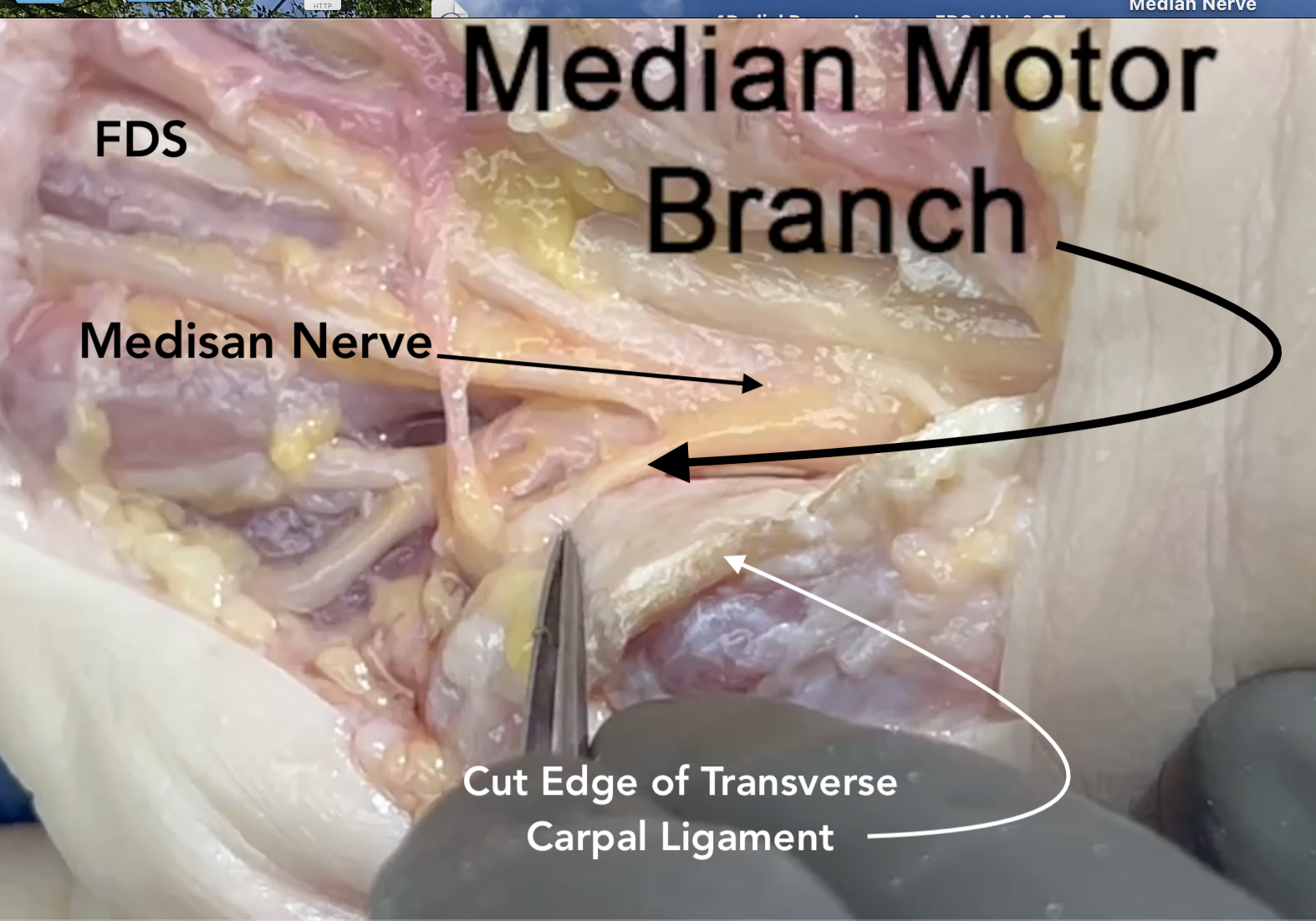 Open carpal tunnel showing the median nerve and its motor branch two the thenar muscles.