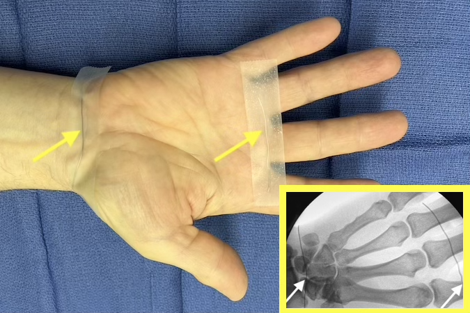Note the wire taped over the palmar wrist crease (white arrow) is over the proximal carpal row. The palmar hand includes a significant portion of the carpal bones.