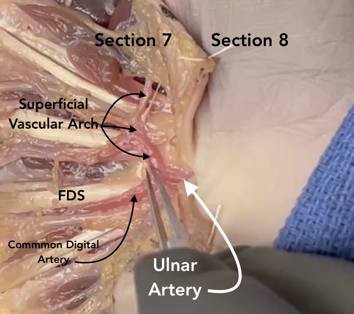 The superficial vascular arch with its connection to the ulnar artery visible.