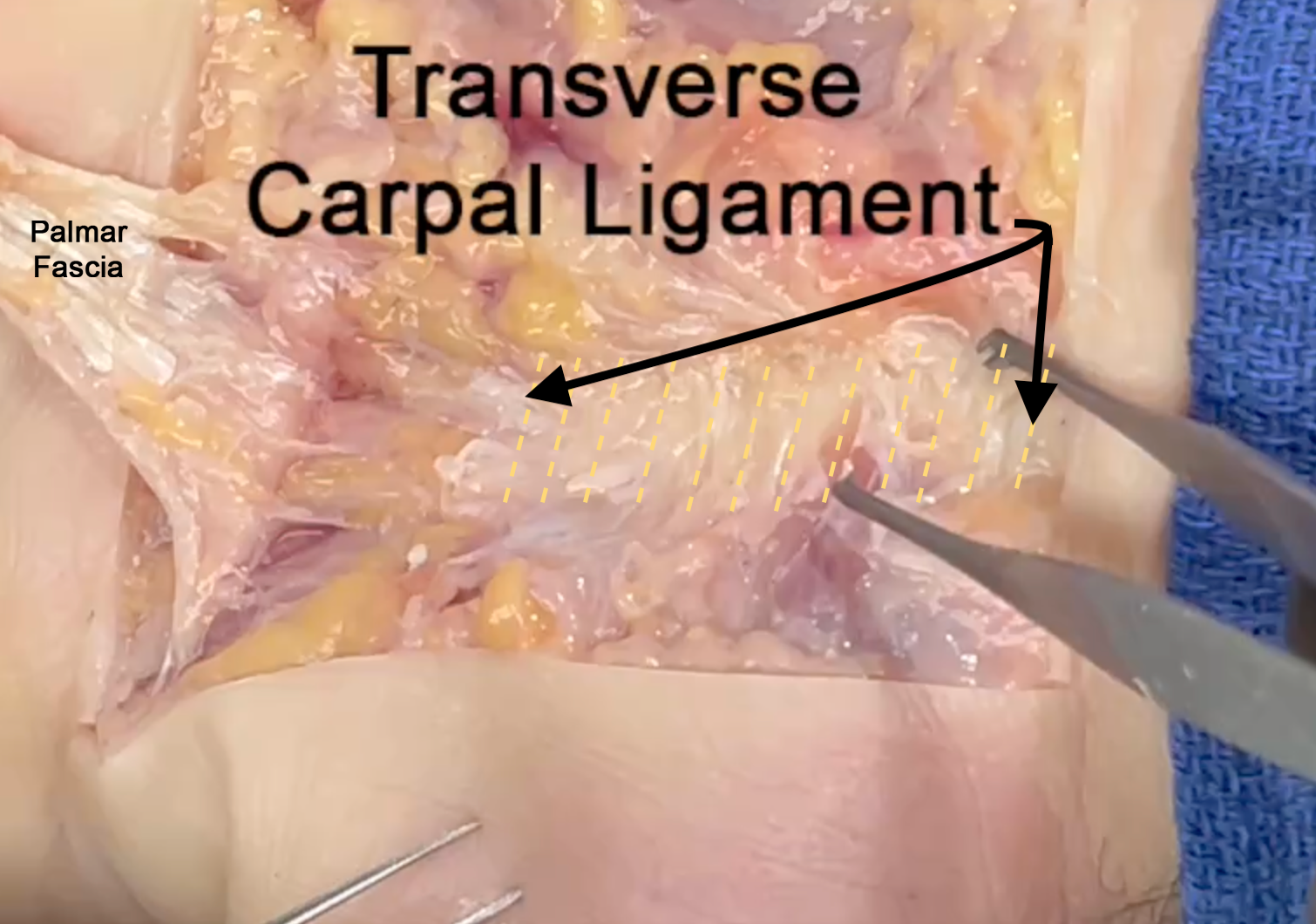 The palmar fascia has been released from the palmaris longs and reflected distally showing the transverse carpal ligament (yellow lines).