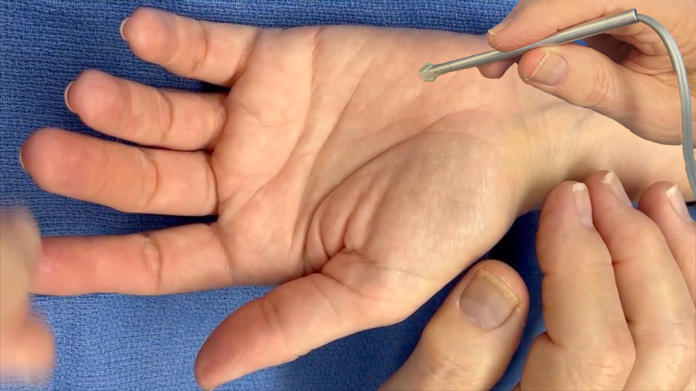 Doppler exam of ulnar artery in Guyon's canal.