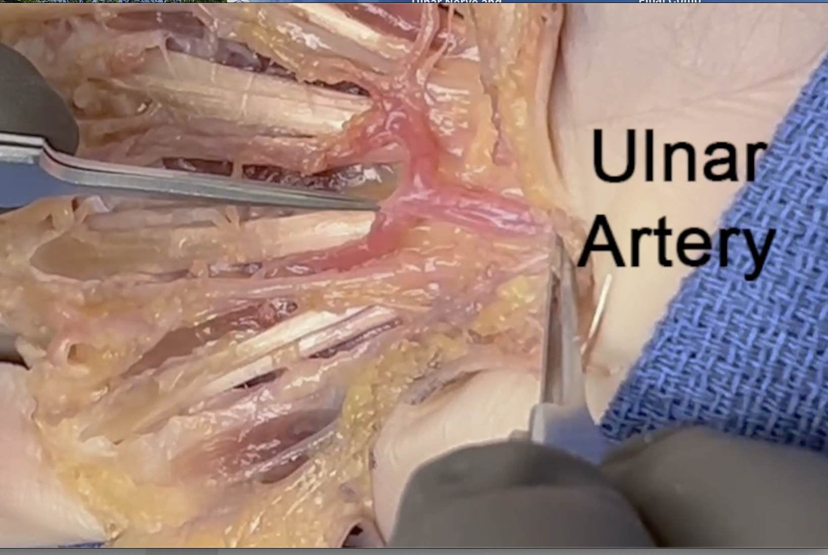 Ulnar artery exiting Guyon's canal at junction of palmar sections 7 and 8.
