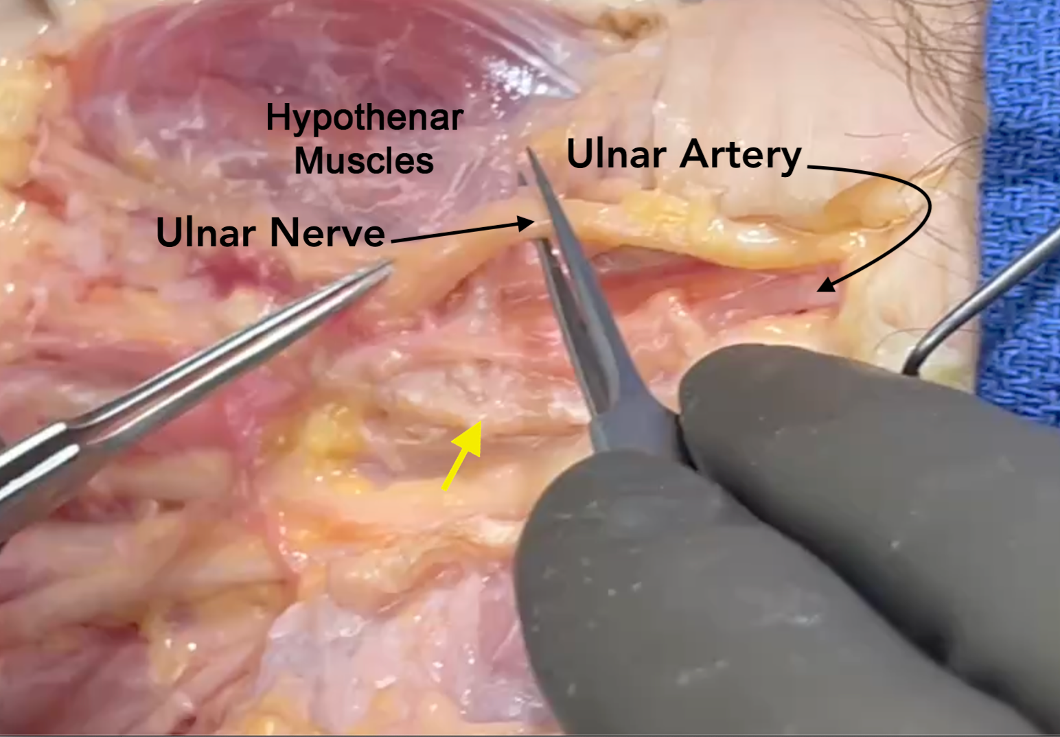 Ulnar artery in Guyon's canal dorsal to ulnar nerve. Yellow arrow at cut edge of pisohamate ligament and transverse carpal ligament.