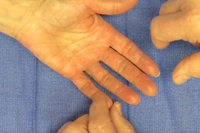 Assessing palmar ulnar nerve sensation by examining light touch in volar tip of the little finger.